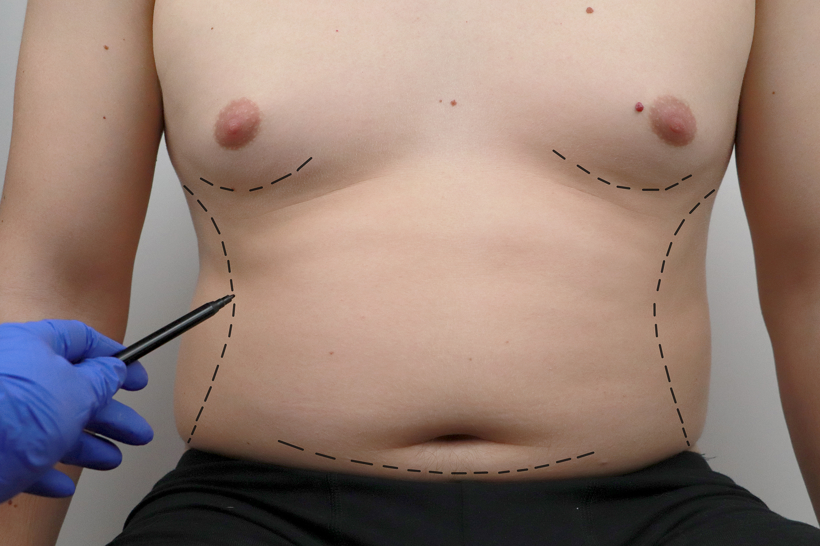 Liposuction and BodyTite™ in Denver, CO Liposuction and BodyTite™ in Denver, CO