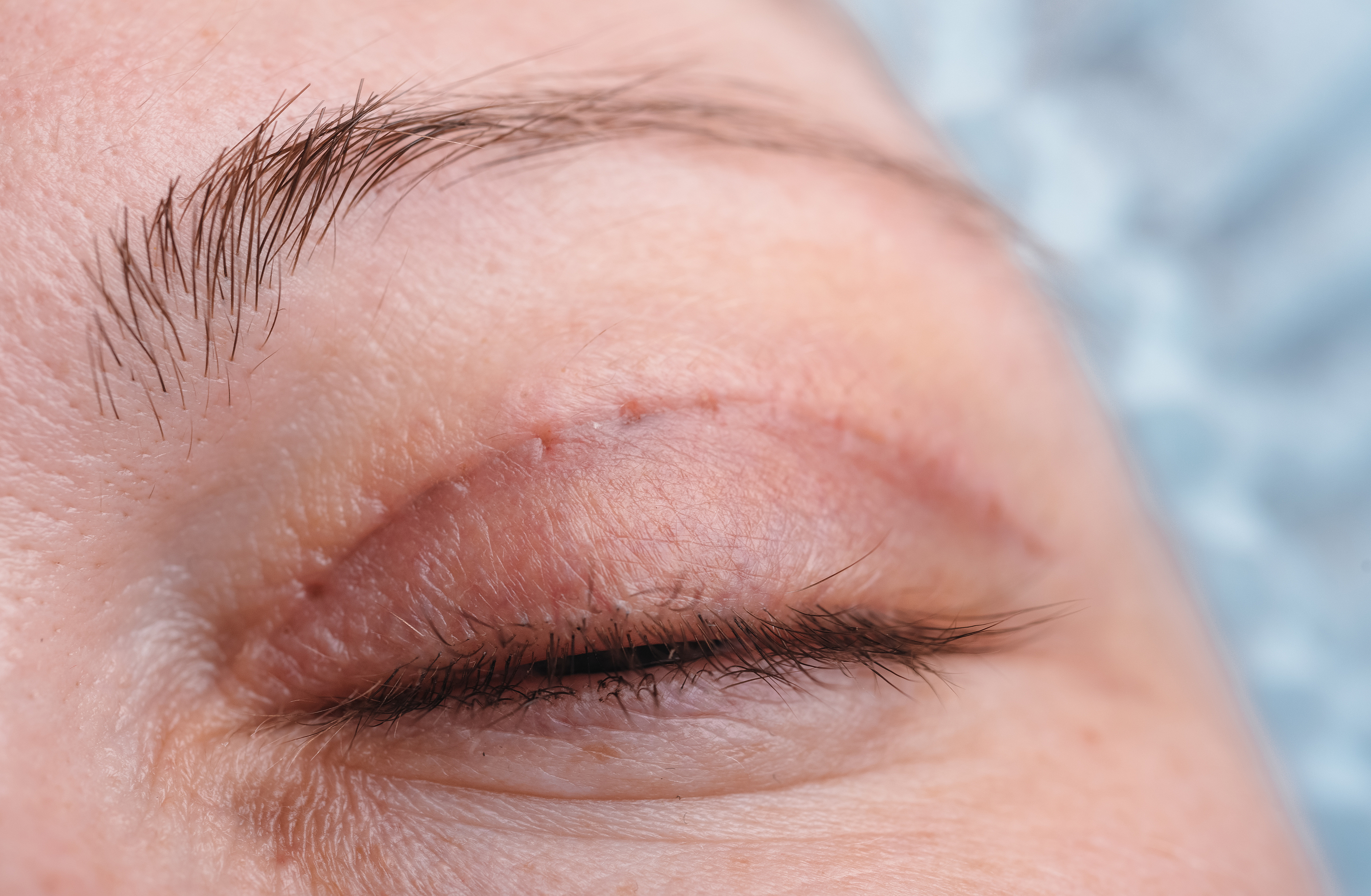Upper Blepharoplasty in Denver, CO Upper Blepharoplasty in Denver, CO