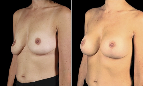 Breast Lift Before and After - Joyce Aycock Patient 1 - 3/4 View Left Facing