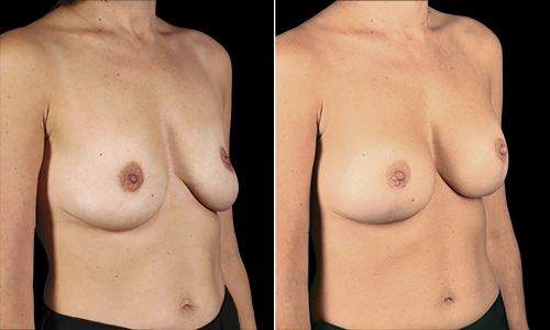 Breast Lift Before and After - Joyce Aycock Patient 1 - 3/4 View Right Facing