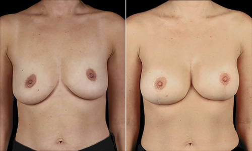 Breast Lift Before and After - Joyce Aycock Patient 1 - Front View