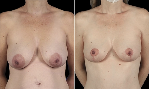 Breast Lift Before and After - Joyce Aycock Patient 2 - Front View