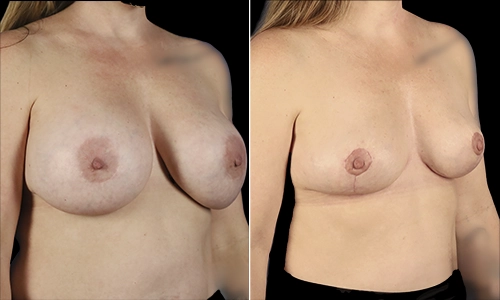 Breast Lift Before and After - Joyce Aycock Patient 3 - 3/4 View Right Facing