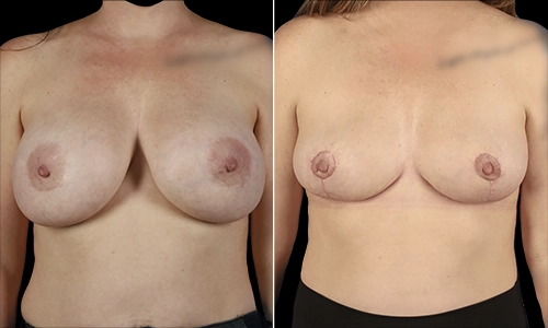 Breast Lift Before and After - Joyce Aycock Patient 3 - Front View