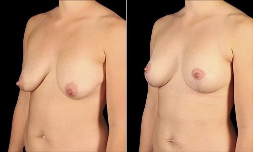 Breast Lift Before and After - Joyce Aycock Patient 4 - 3/4 View Left Facing