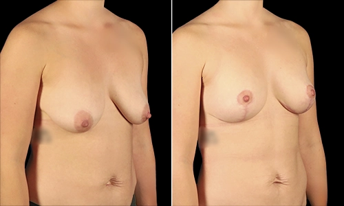 Breast Lift Before and After - Joyce Aycock Patient 4 - 3/4 View Right Facing