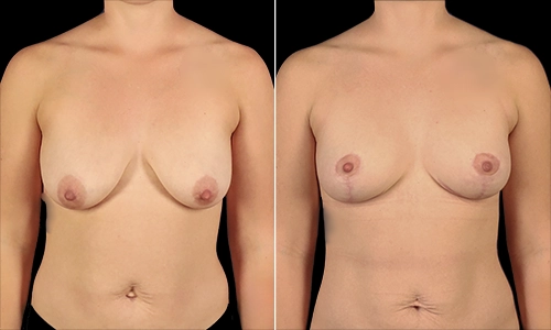 Breast Lift Before and After - Joyce Aycock Patient 4 - Front View