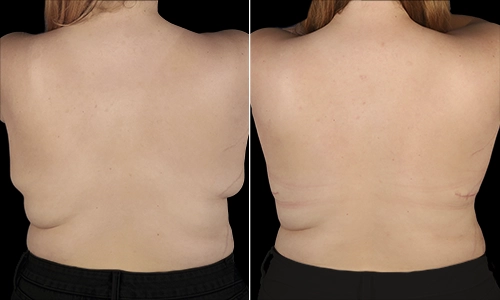 Breast Lift Before and After - Joyce Aycock Patient 5 - Back View