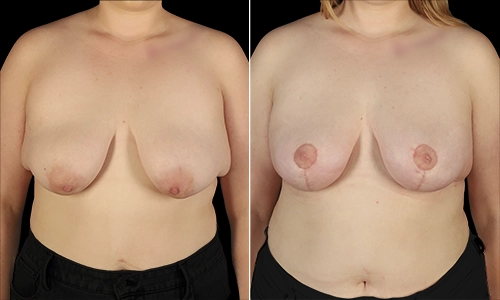 Breast Lift Before and After - Joyce Aycock Patient 5 - Front View