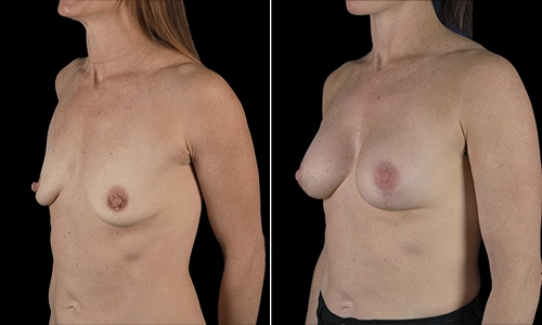 Breast Lift Before and After - Joyce Aycock Patient 6 - 3/4 View Left Facing