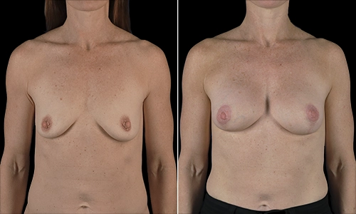 Breast Lift Before and After - Joyce Aycock Patient 6 - Front View