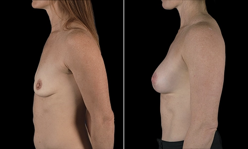 Breast Lift Before and After - Joyce Aycock Patient 6 - Side View
