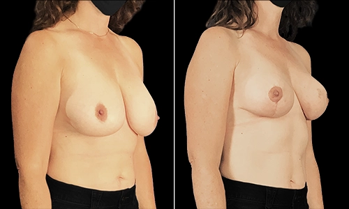 Breast Lift Before and After - Joyce Aycock Patient 7 - 3/4 View Right Facing