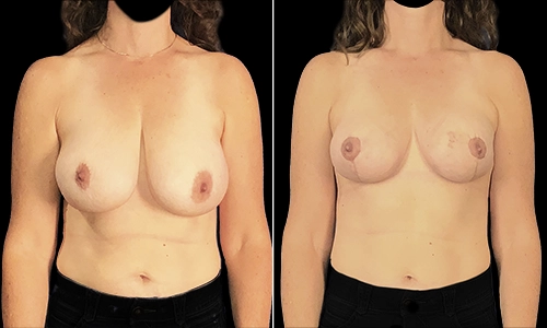Breast Lift Before and After - Joyce Aycock Patient 7 - Front View
