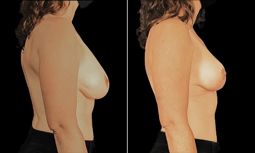 Breast Lift Before and After - Joyce Aycock Patient 7 - Side View