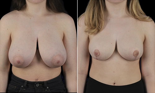 Breast Reduction Before and After - Joyce Aycock Patient 10 - Front View