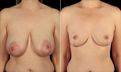 Breast Reduction Before and After - Joyce Aycock Patient 2 - Front View