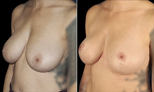 Breast Reduction Before and After - Joyce Aycock Patient 5 - 3/4 View Left Facing