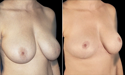 Breast Reduction Before and After - Joyce Aycock Patient 5 - 3/4 View Right Facing