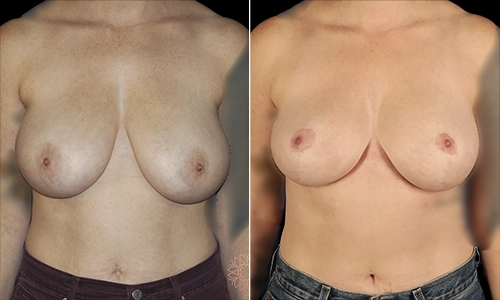 Breast Reduction Before and After - Joyce Aycock Patient 5 - Front View