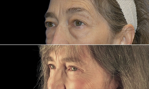 Eyelid Lift Before and After - Joyce Aycock Patient 1 - 3/4 View Left Facing