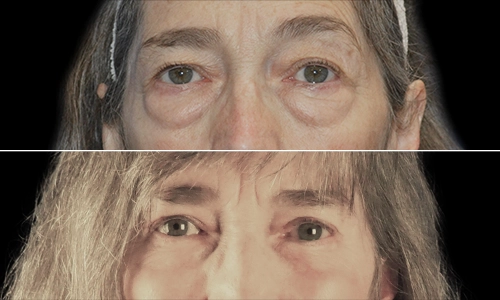 Eyelid Lift Before and After - Joyce Aycock Patient 1 - Front View