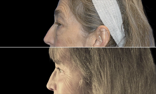Eyelid Lift Before and After - Joyce Aycock Patient 1 - Side View