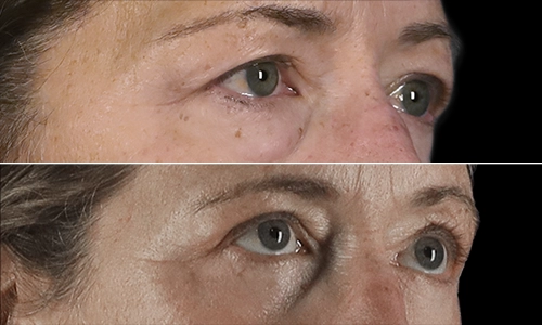 Eyelid Lift Before and After - Joyce Aycock Patient 4 - 3/4 View Right Facing