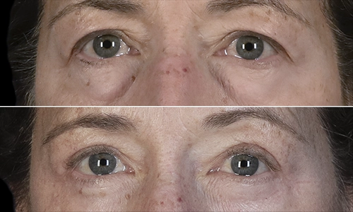 Eyelid Lift Before and After - Joyce Aycock Patient 4 - Front View