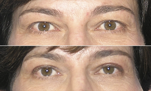 Eyelid Lift Before and After - Joyce Aycock Patient 5 - Front View