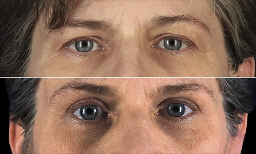 Eyelid Lift Before and After - Joyce Aycock Patient 6 - Front View