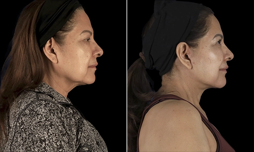 Facelift Before and After - Joyce Aycock Patient 4 - Side View
