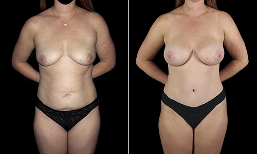 Mommy Makeover Before and After - Joyce Aycock Patient 3 - Front View