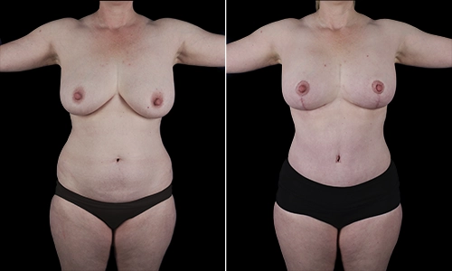 Mommy Makeover Before and After - Joyce Aycock Patient 5 - Front View