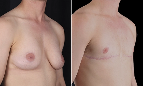 Top Surgery Before and After - Joyce Aycock Patient 12 - 3/4 View Right Facing