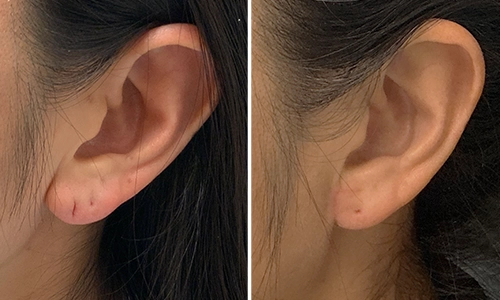 Dr. Aycock earlobe repair before and after patient 1 - tear with "V-Y flap" technique for a notch-free repair