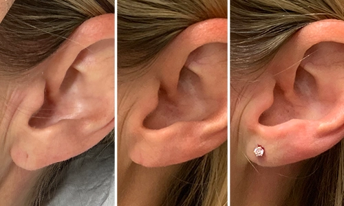 Dr. Aycock earlobe repair before and after patient 2 - tear with "V-Y flap" technique for a notch-free repair and re-piercing.
